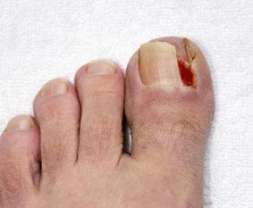 Ingrown Toenails