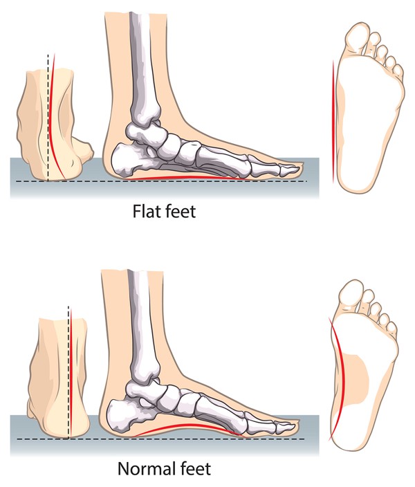 Flat Feet Treatment Island Foot Clinics