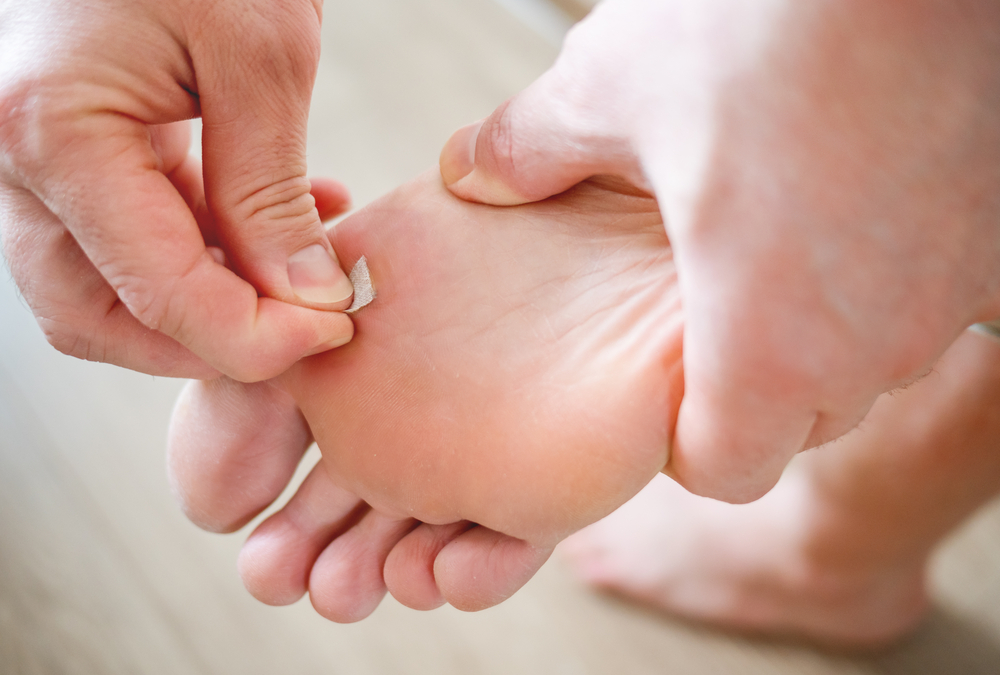 What’s the Best Way to Get Rid of Plantar Warts?