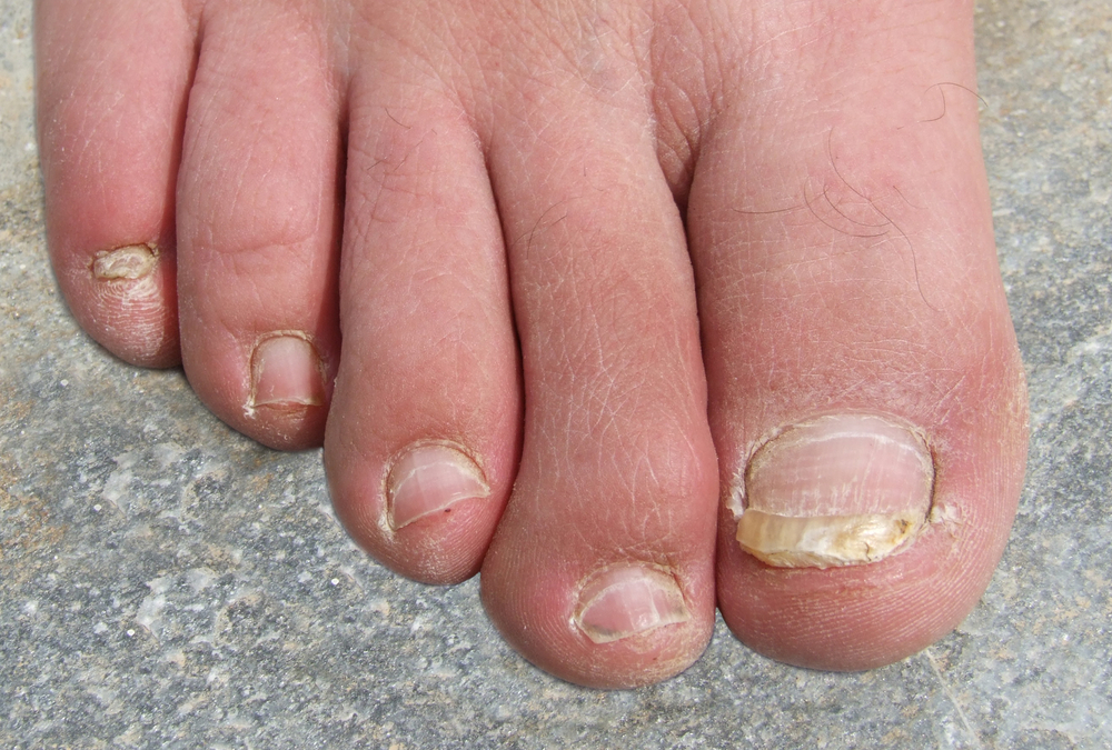 Ask a Foot Doctor: What Causes Thick or Discolored Toenails?